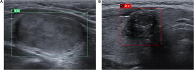 A Clinical Assessment of an Ultrasound Computer-Aided Diagnosis System in Differentiating Thyroid Nodules With Radiologists of Different Diagnostic Experience